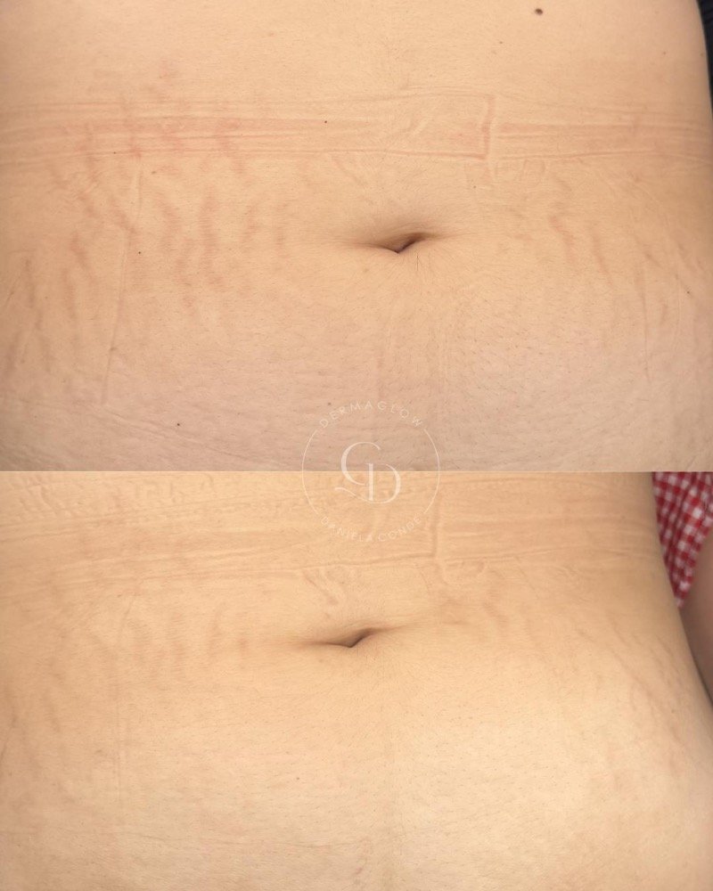 Antes e depois do tratamento de estrias no abdómen, após 2 sessões