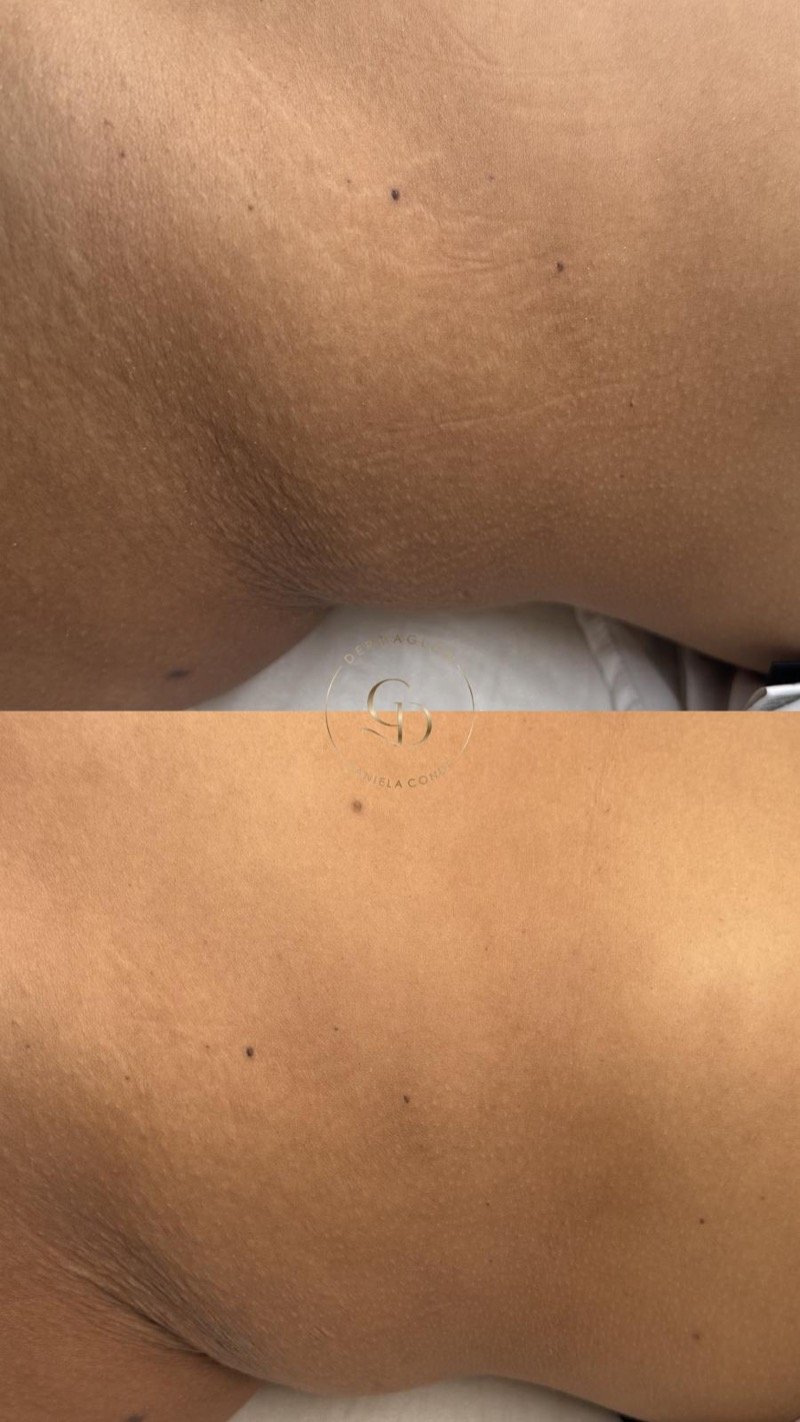 Antes e depois do tratamento de estrias numa zona de dobra, após 1 sessão