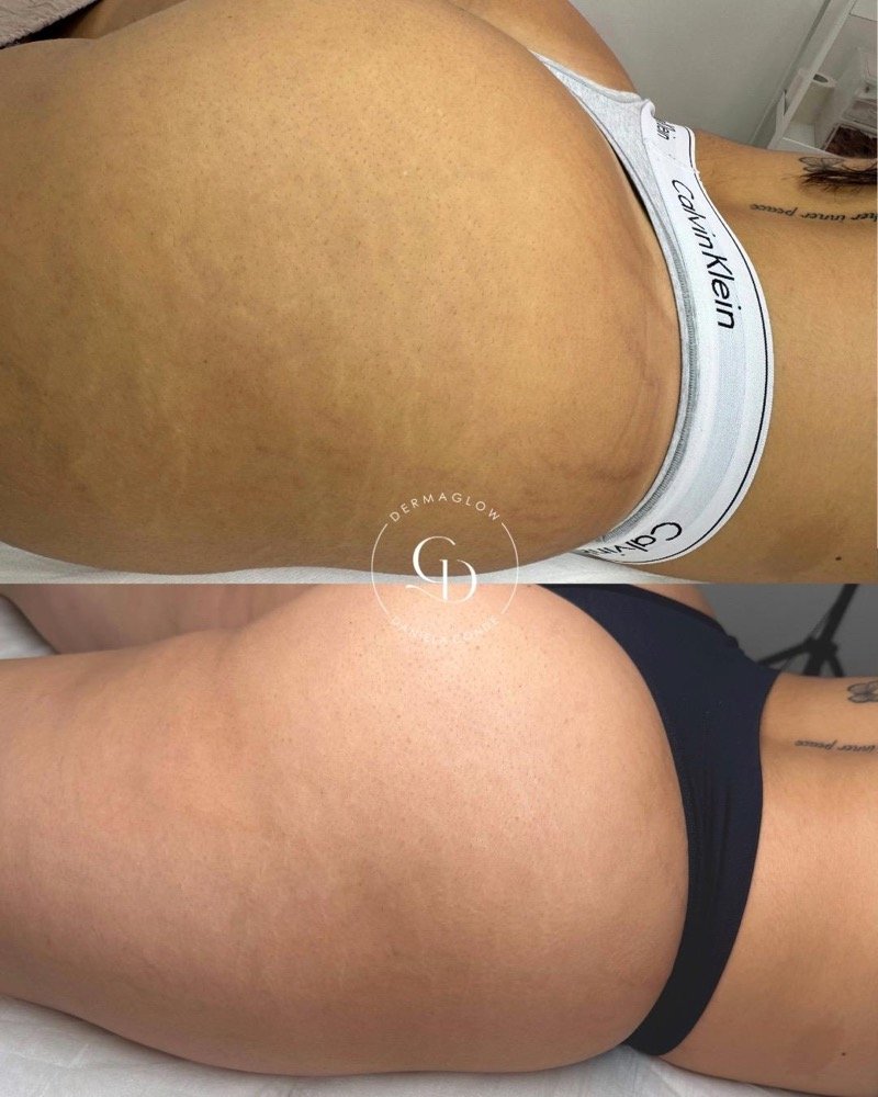 Antes e depois do tratamento de estrias no glúteo, após 3 sessões