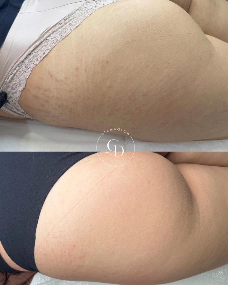 Antes e depois do tratamento de estrias na coxa e glúteo, após 4 sessões