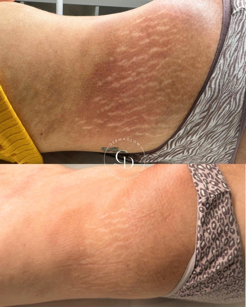 Antes e depois do tratamento de estrias na zona lombar, após 2 sessões